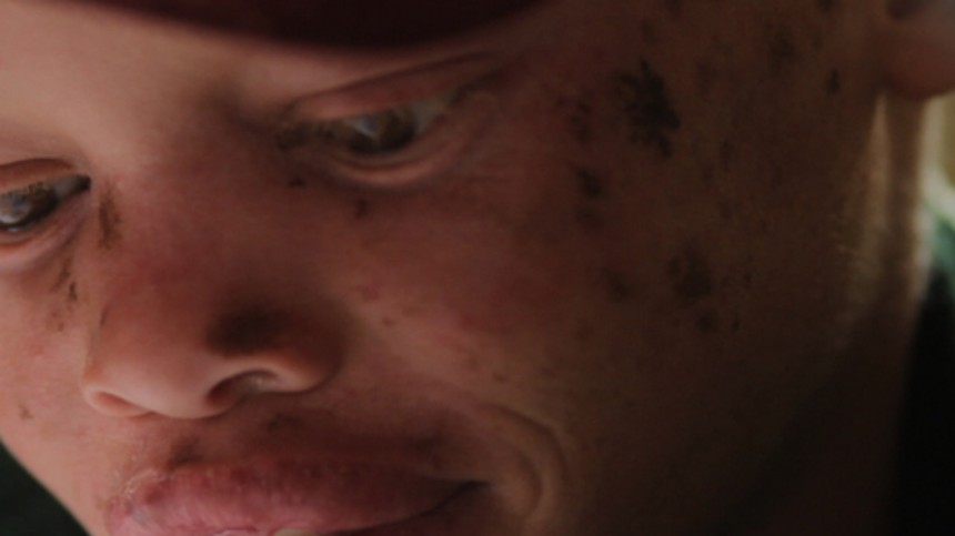 Albino med ansigt som en åben bog