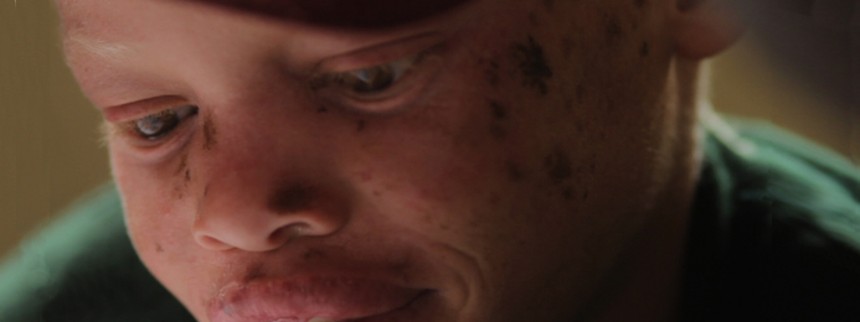 Albino med ansigt som en åben bog